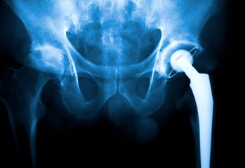 hip replacement doctor in jalandhar