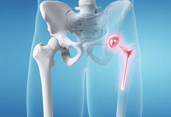 hip replacement Surgeon in jalandhar