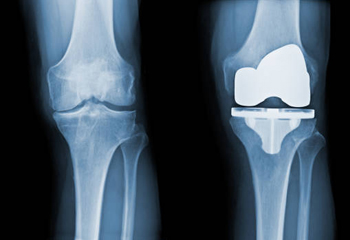 fracture and joint replacement Surgeon in jalandhar