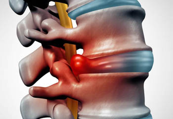 Slipped disc operation with microscope doctor in jalandhar